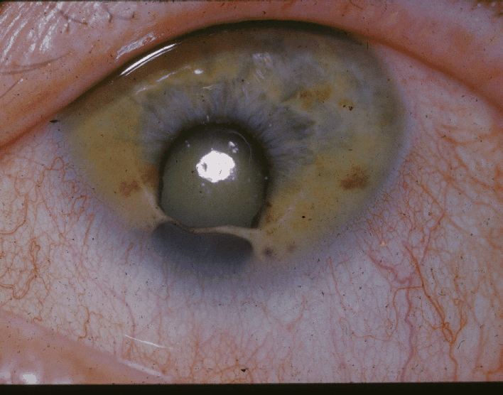 Coloboma de iris 2 Coloboma de iris 1