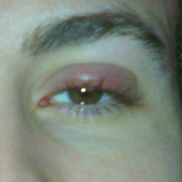 Orzuelos 2 Los orzuelos que se describen en la bibliografía son parecidos a este, que está inflamado, enrojecido pero controlado. Es una inflamación por la infección de las glándulas sebáceas por estafilococos.